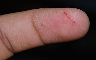 cut finger