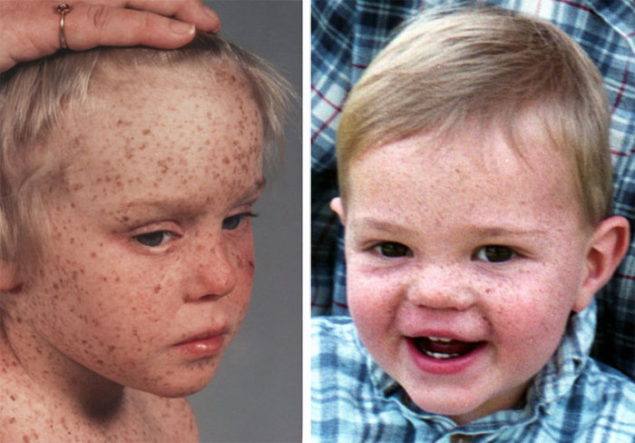 patients-with-xeroderma-pigmentosum